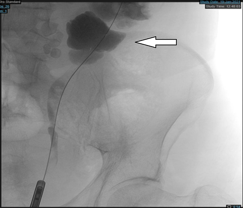 Cureus Upper Urinary Tract Urothelial Carcinoma With Squamous, Glandular, and