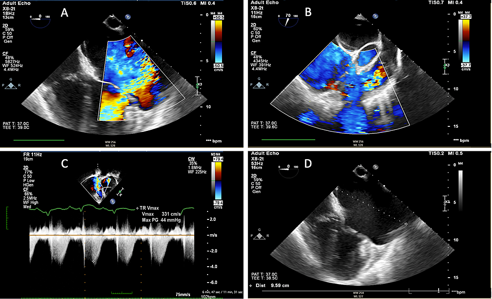 Cureus | The Role of Cardiovascular Surgery in the Management of a ...