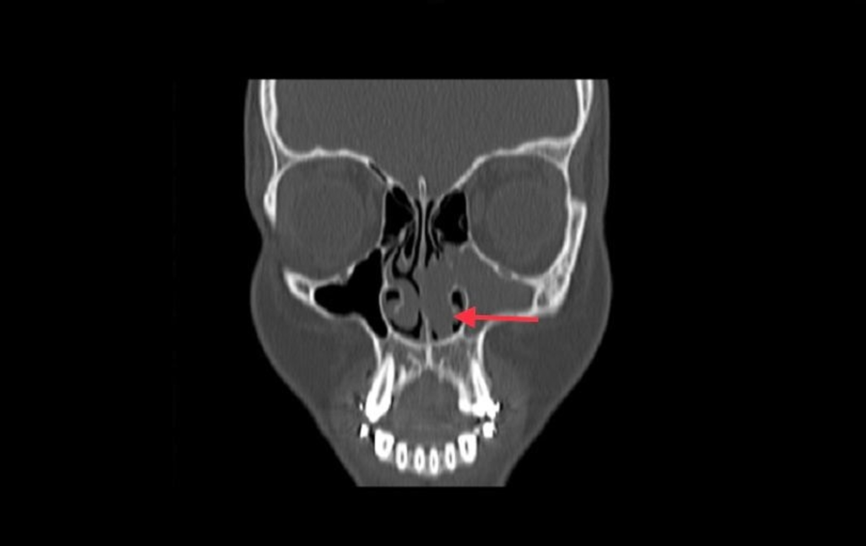 Cureus | Antrochoanal Polyp in Anterior Nasal Cavity: A Case Report