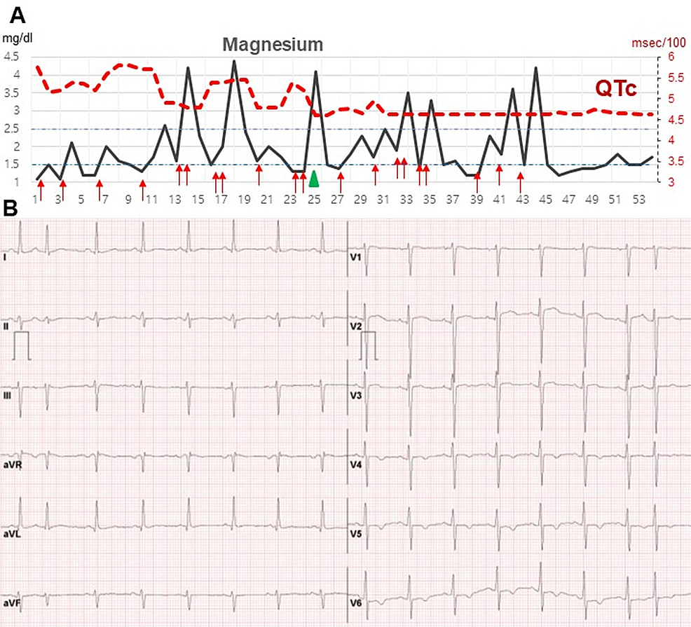 Cureus Ventricular Arrhythmia Associated With Magnesium and Vitamin D
