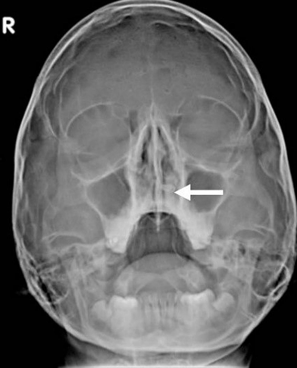 Plain-x-ray-shows-the-radiopaque-structure-in-the-left-nasal-cavity,-embedded-in-the-hard-palate-(white-arrow).