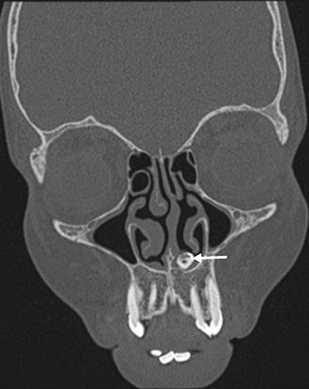 Coronal-image-showing-a-bone-like-structure-(white-arrow)-embedded-in-the-hard-palate-extending-into-the-left-nasal-cavity.