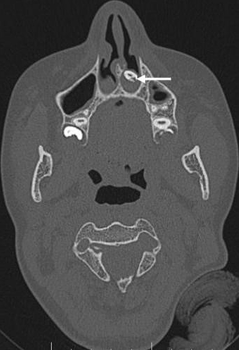 Axial-CT-scan-showing-an-ectopic-tooth-in-the-left-nasal-cavity-surrounded-by-soft-tissue-(white-arrow).