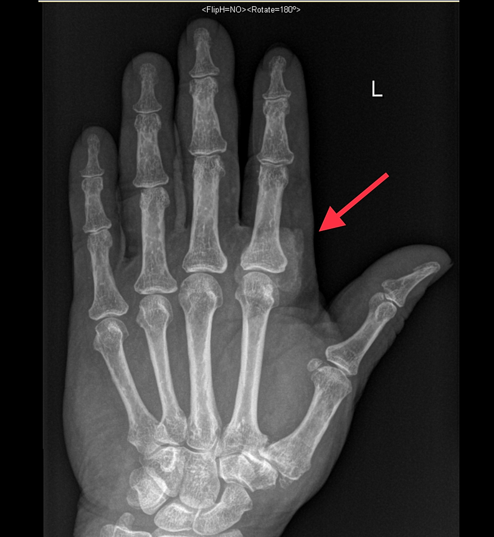 Cureus | Chondroblastoma-Like Soft-Tissue Chondroma of the Hand: A Case ...