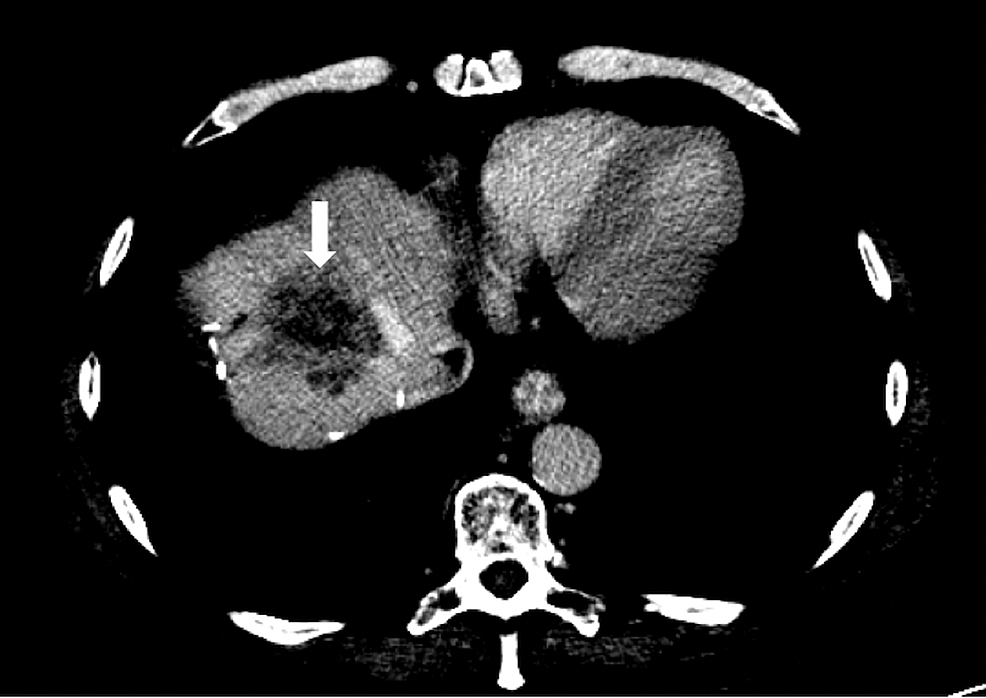 Axial-CT-abdomen-in-the-portovenous-phase-in-liver-window-demonstrating-the-segment-4a-tumor-(white-arrow).
