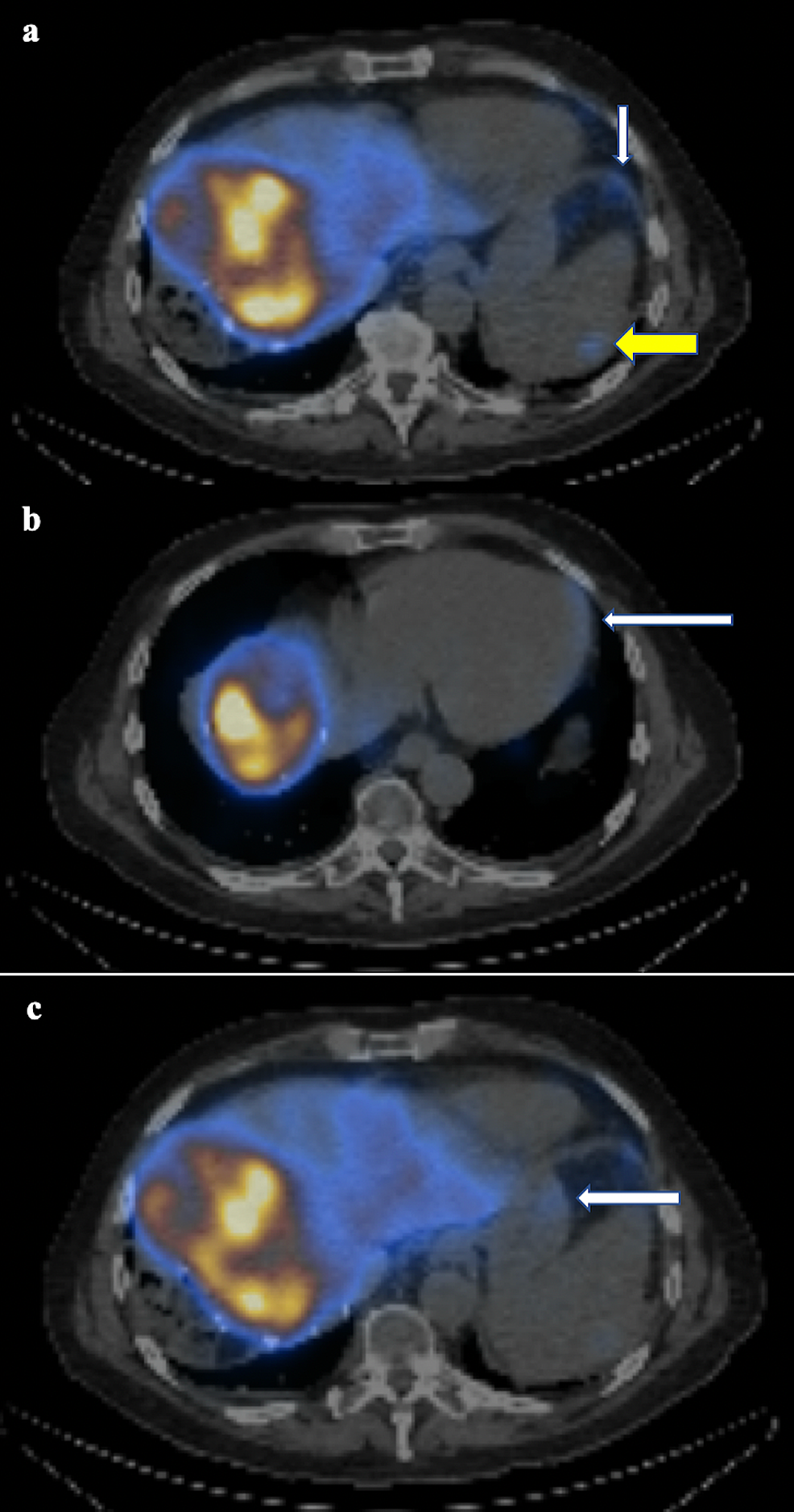 Axial-SPECT-images-demonstrating-small-amounts-of-activity-in-the-diaphragm-(a,-white-arrow),-spleen-(a,-yellow-arrow),-pericardium-(b,-white-arrow),-and-stomach-(c,-white-arrow).