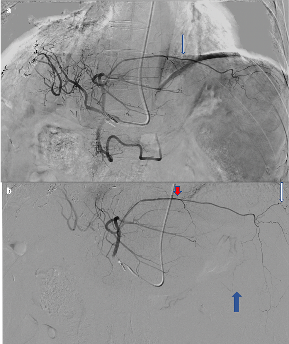 DSA-angiogram-from-the-left-main-hepatic-artery-demonstrating-the-anomalous-branch-(a,-white-arrow),-and-angiogram-following-selection-of-the-anomalous-branch-with-a-microcatheter-(b)-demonstrating-branches-supplying-the-pericardium-(red-arrow),-spleen-(white-arrow),-and-stomach-(blue-arrow).