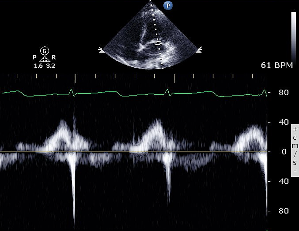 Cureus | Hidden in Plain Sight: A Case of Arrhythmic Mitral Valve ...