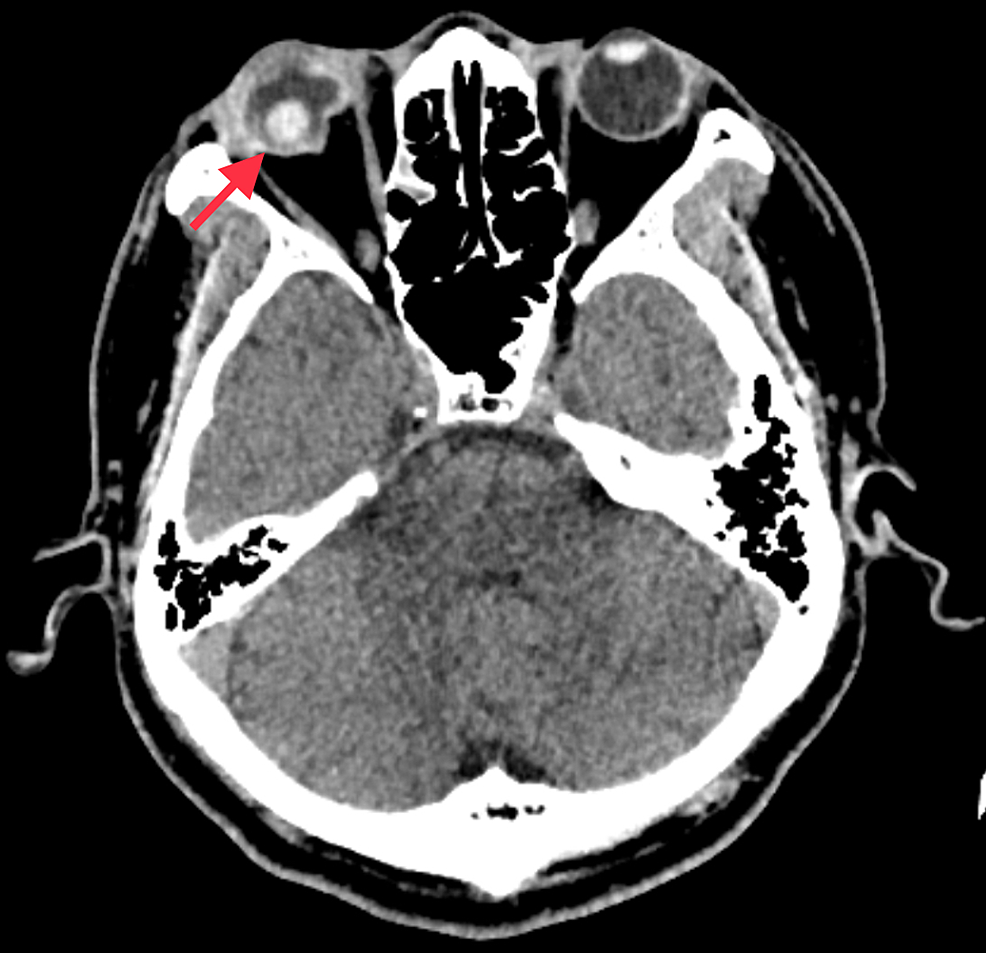 Axial-cut-of-CT-scan-shows-right-globe-rupture-with-posteriorly-dislocated-crystalline-lens-(red-arrow).