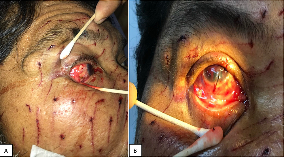 Multiple-superficial-puncture-wounds-over-the-right-side-of-the-face-(A)-and-right-upper-lid-laceration-with-corneal-and-scleral-laceration-wound-and-traumatic-hyphema-(B).