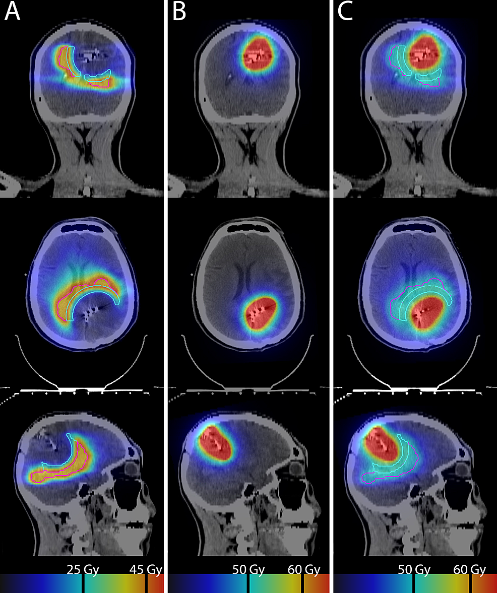 GammaTile Brachytherapy Combined With External Beam Radiation Therapy ...