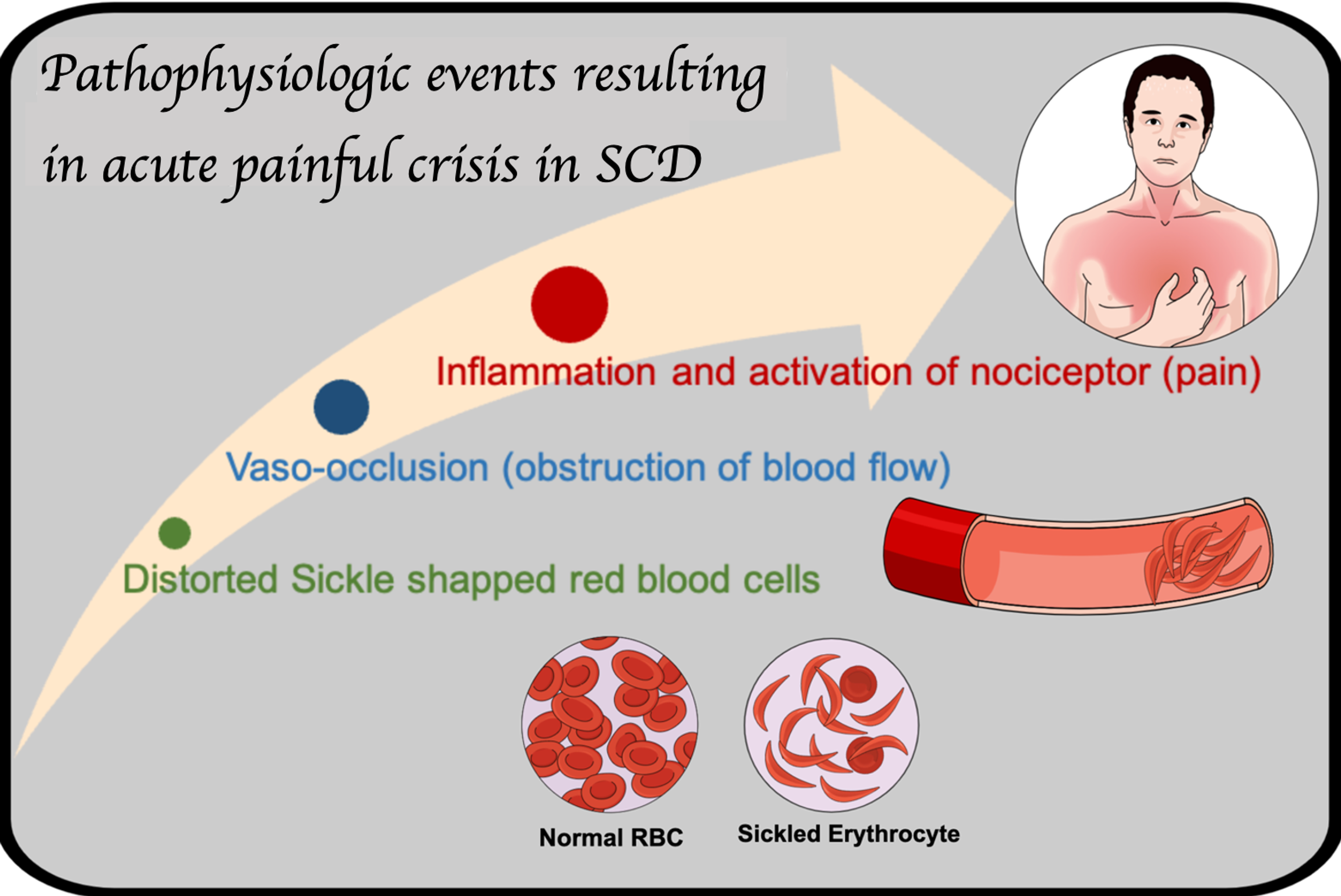 cureus-opioid-use-in-patients-with-sickle-cell-disease-during-a-vaso