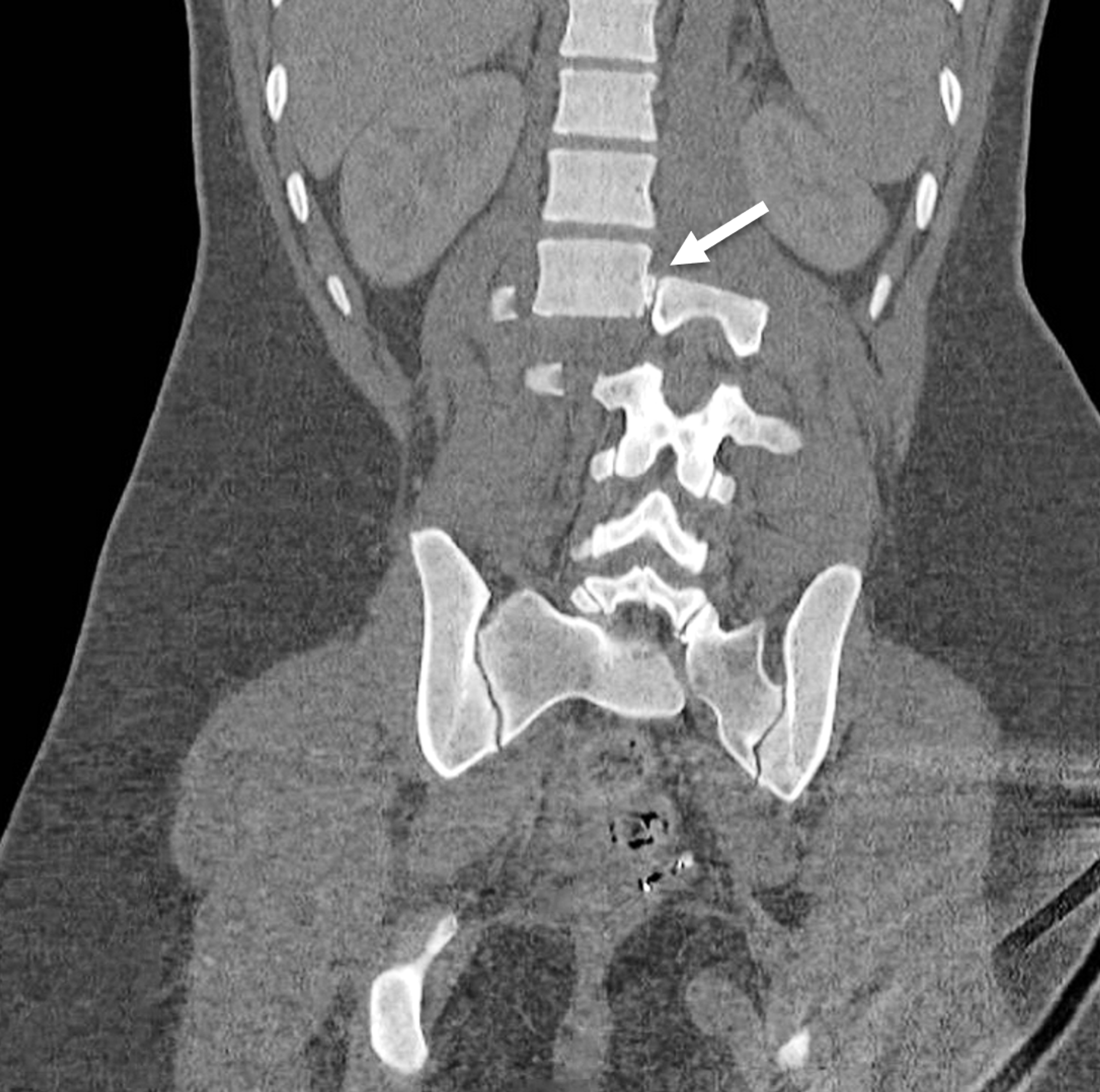 Magnetic Resonance Imaging (MRI): Lumbar Spine (for Parents) - Nemours KidsHealth