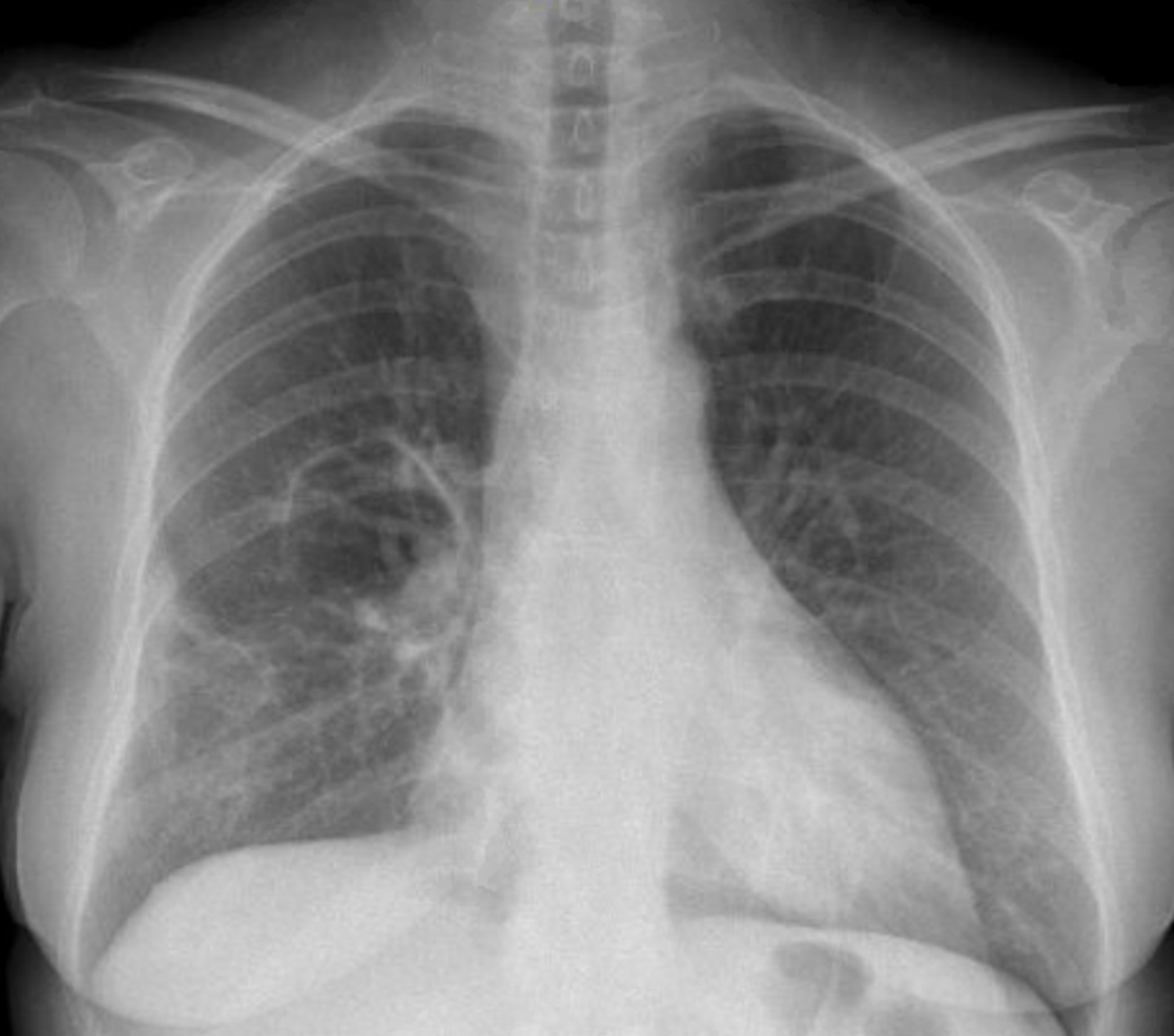 Cureus | Rare Overlap of Granulomatosis With Polyangiitis in a Patient ...