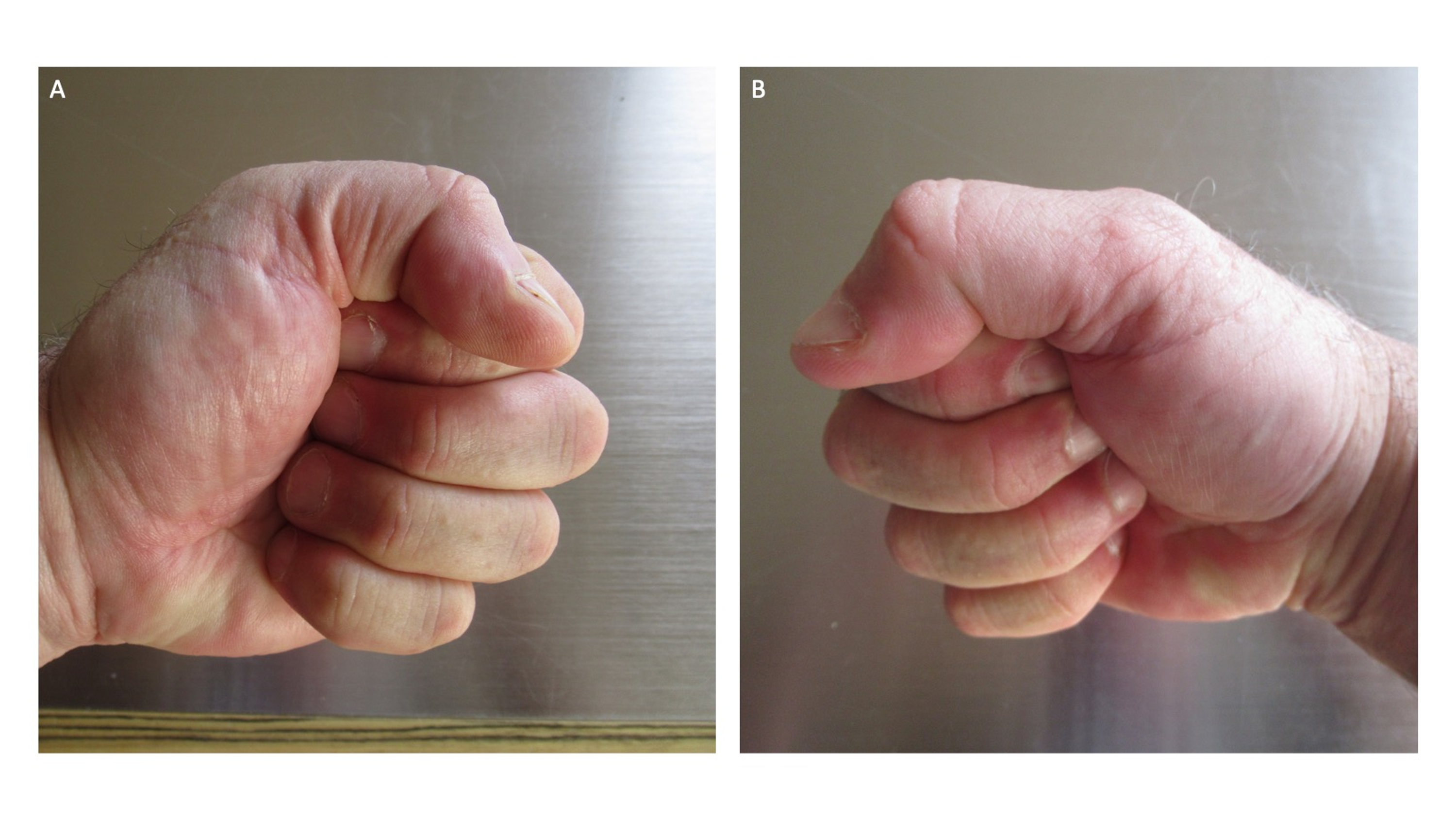 Post Ambulatory Swollen Hands (POTASH picture