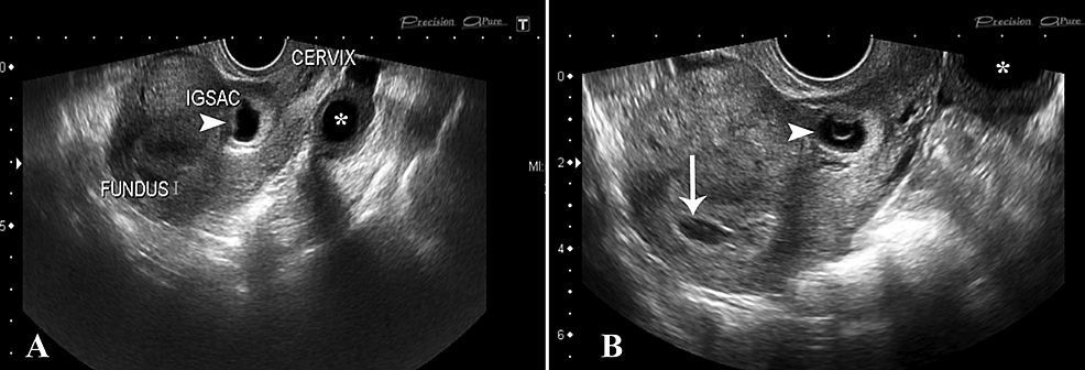 Cesarean Scar Pregnancy: An Experience of Three Cases with Review of ...