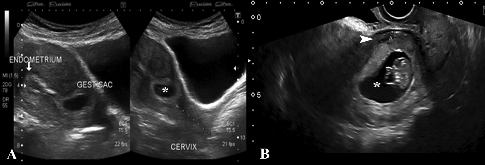 Ultrasound empty sac tilted uterus Tilted Uterus: