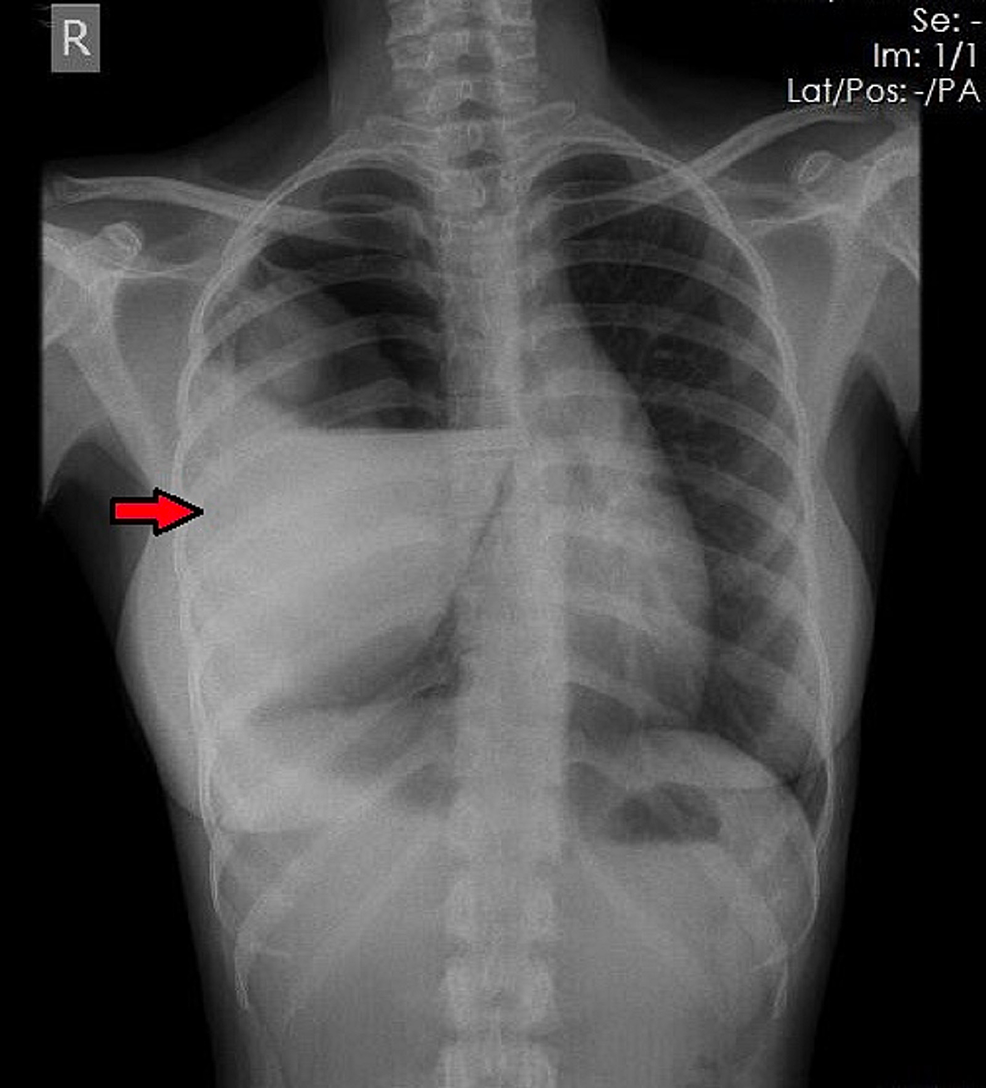 Preoperative-chest-x-ray-showing-a-right-hydropneumothorax