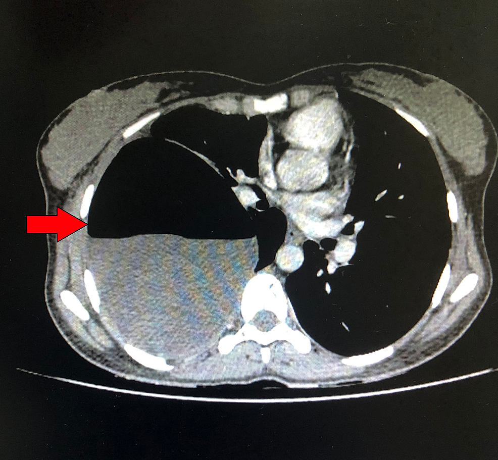 CT-chest-showing-a-well-defined-fluid-filled-cystic-lesion-in-the-right-hemithorax