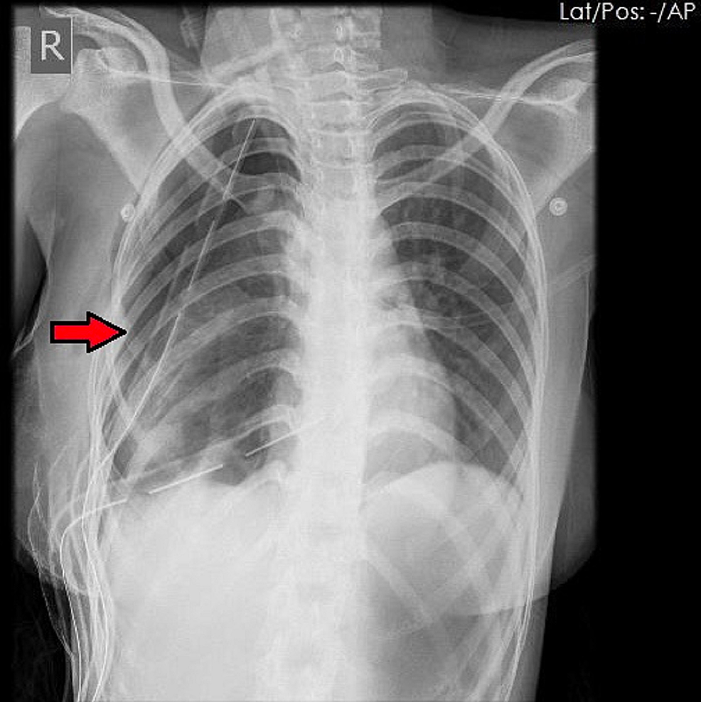 Postoperative-chest-x-ray-showing-right-lung-collapse