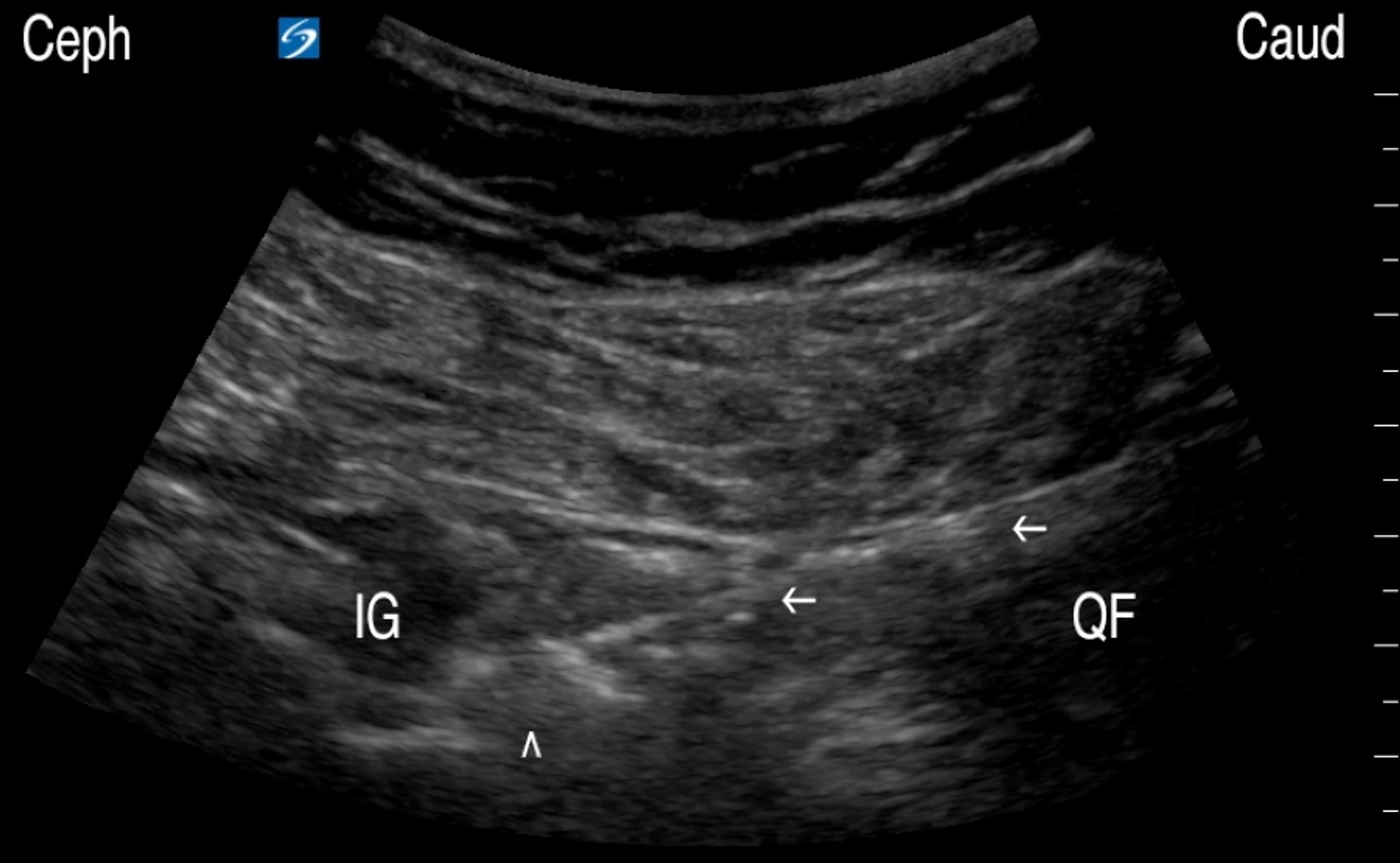 Cureus | A Novel Treatment Approach Of Ultrasound-Guided Radiofrequency ...