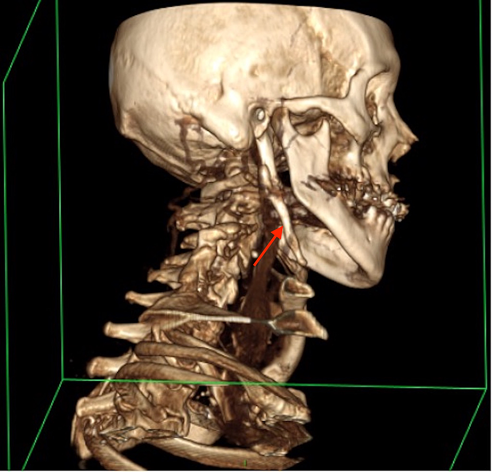 Ossified Stylohyoid Ligament Lateral View Figure 2 Or - vrogue.co