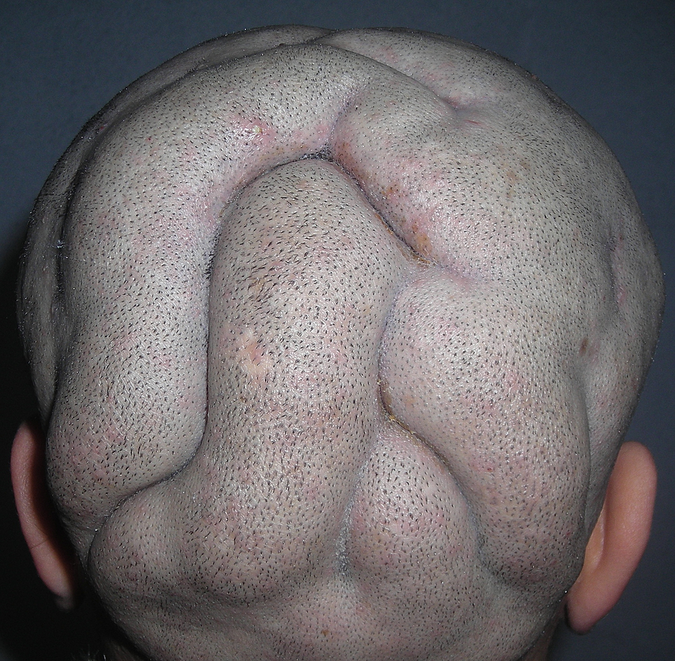Longitudinal-folds-involving-parietal-and-occipital-areas.