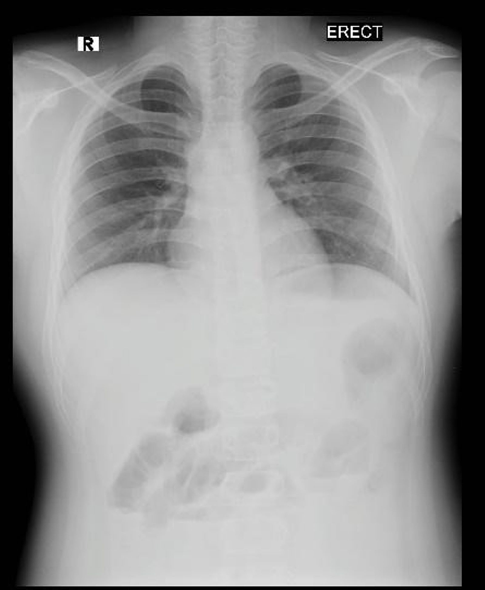 Erect-chest-X-ray-showing-normal-anatomy.