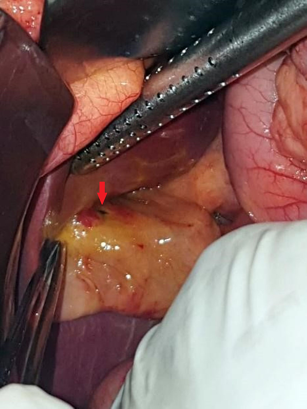 Intraoperative-specimen-showing-a-small-pinpoint-perforation-(arrow)-of-less-than-5-mm-in-the-gallbladder.-