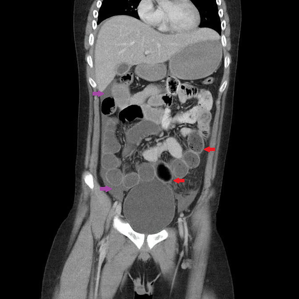 Abdominal-computed-tomography-scan-with-contrast-showing-free-fluid-(purple-arrows)-around-the-liver,-in-the-right-iliac-fossa,-and-pelvis,-with-dilated-small-bowel-loops-(red-arrows).