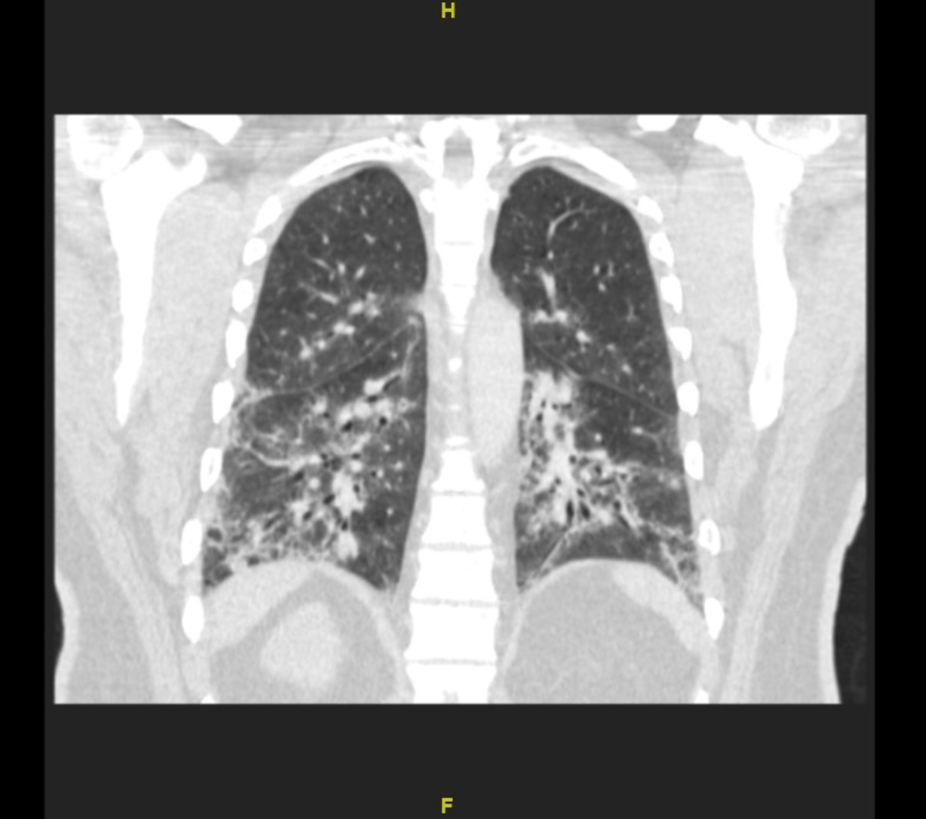 Cureus | Cryptogenic Organizing Pneumonia Secondary to Mycoplasma ...