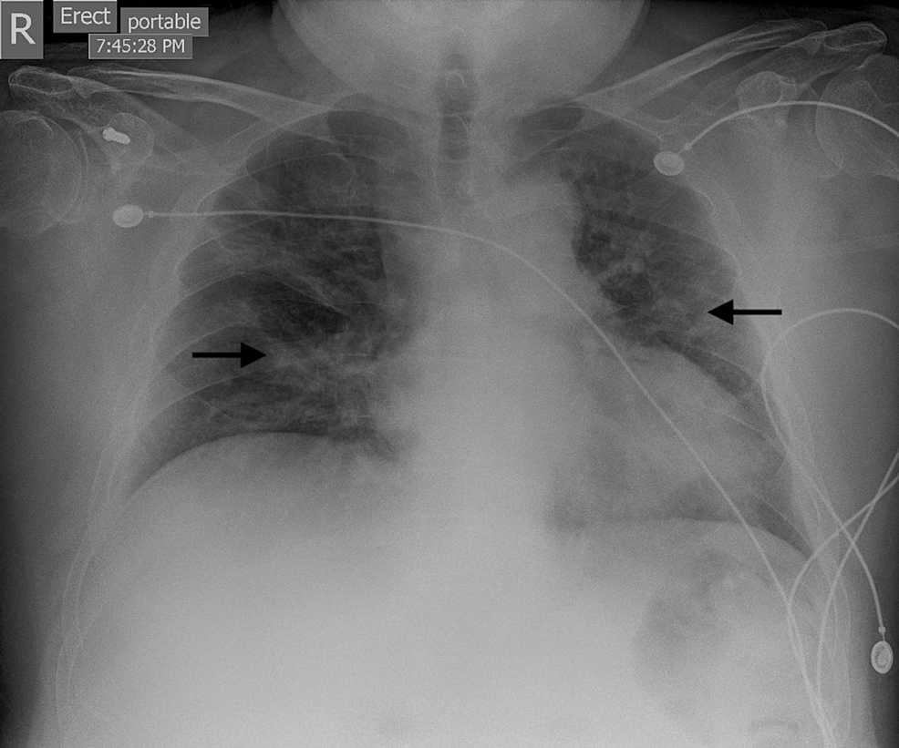The Emergence of Cryptococcemia in COVID-19 Infection: A Case Report |  Cureus