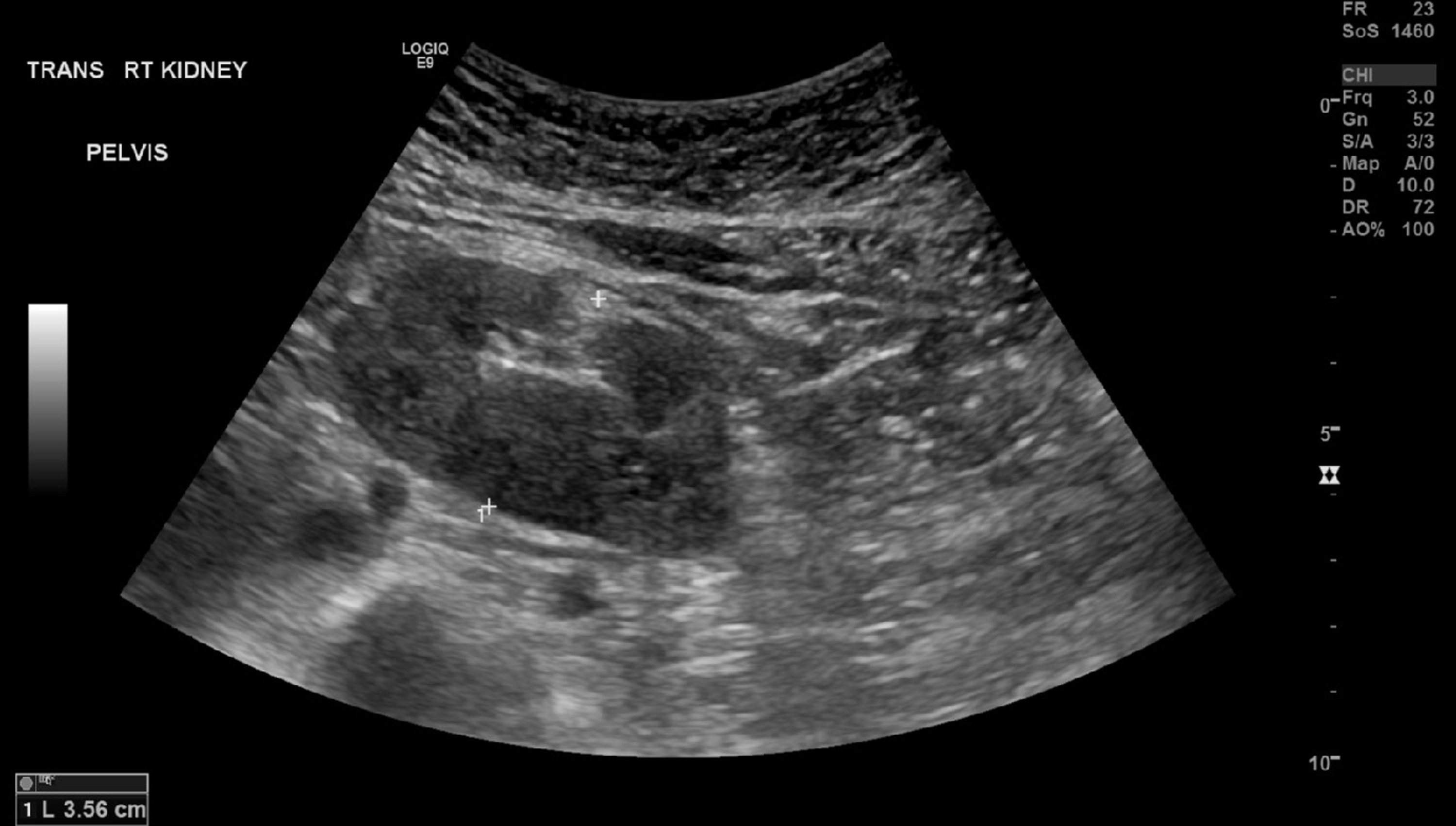 Cureus | Bardet-Biedl Syndrome With Renal, Cardiac, and Genitourinary ...