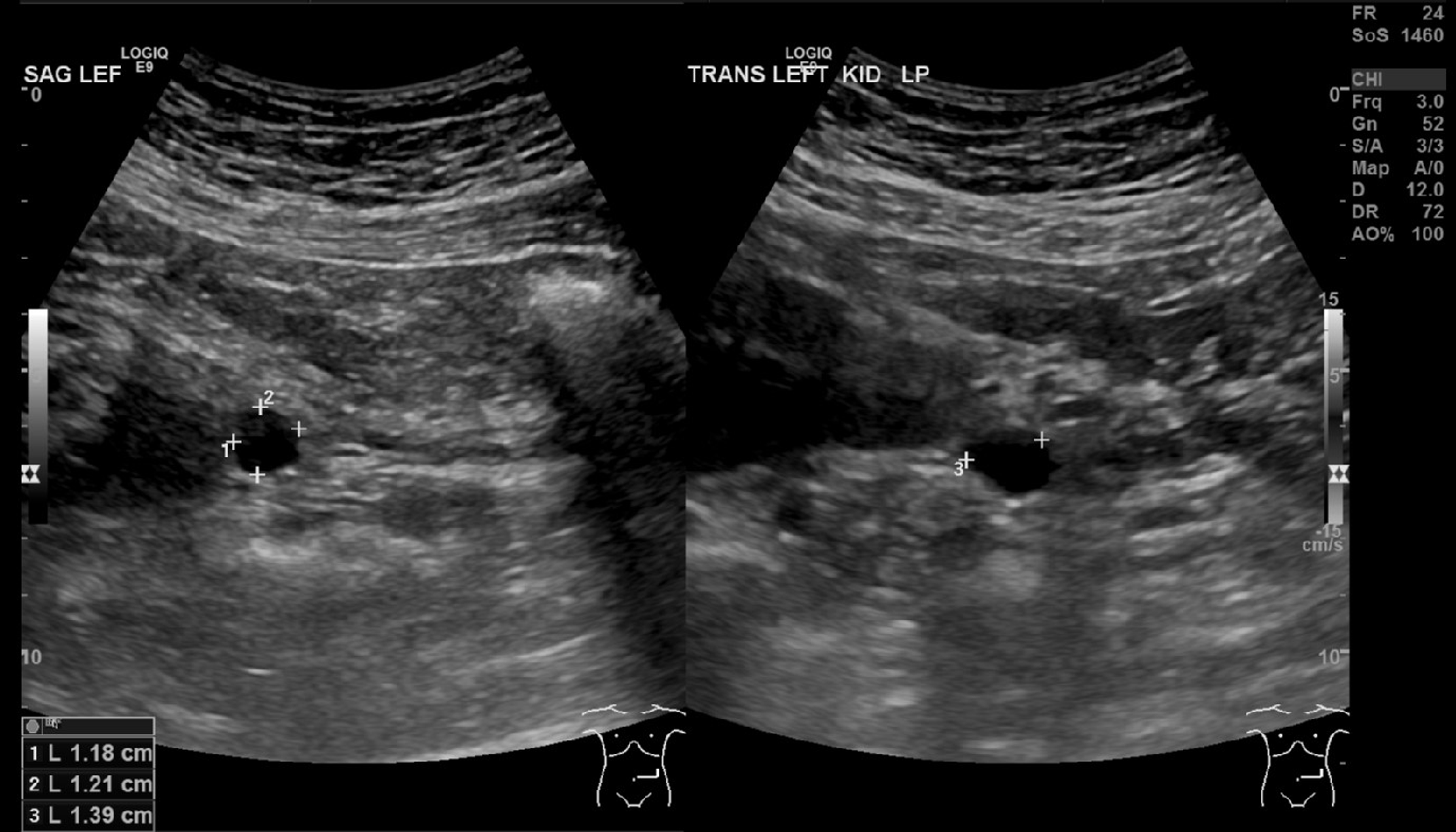 Cureus | Bardet-Biedl Syndrome With Renal, Cardiac, and Genitourinary ...