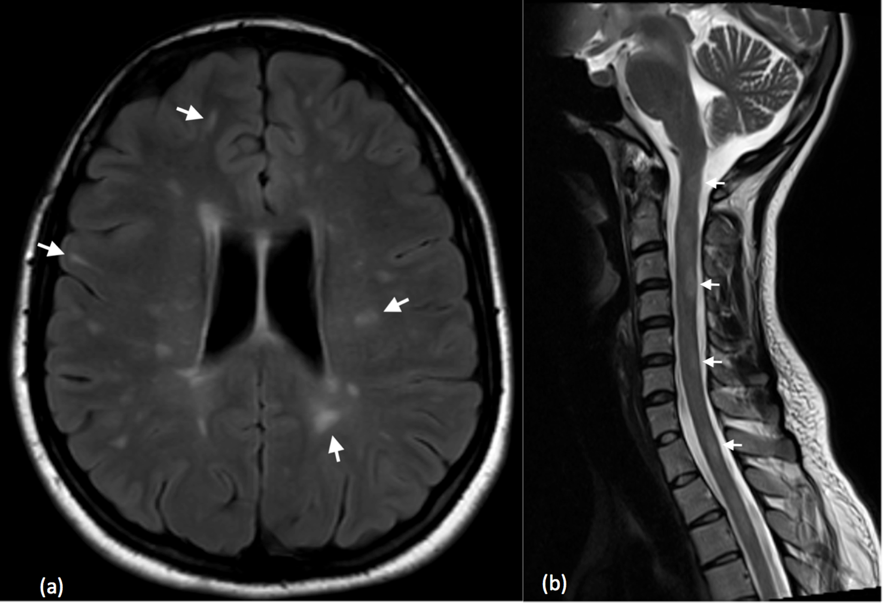 Intramedullary Lesions Multiple Neupsy Key