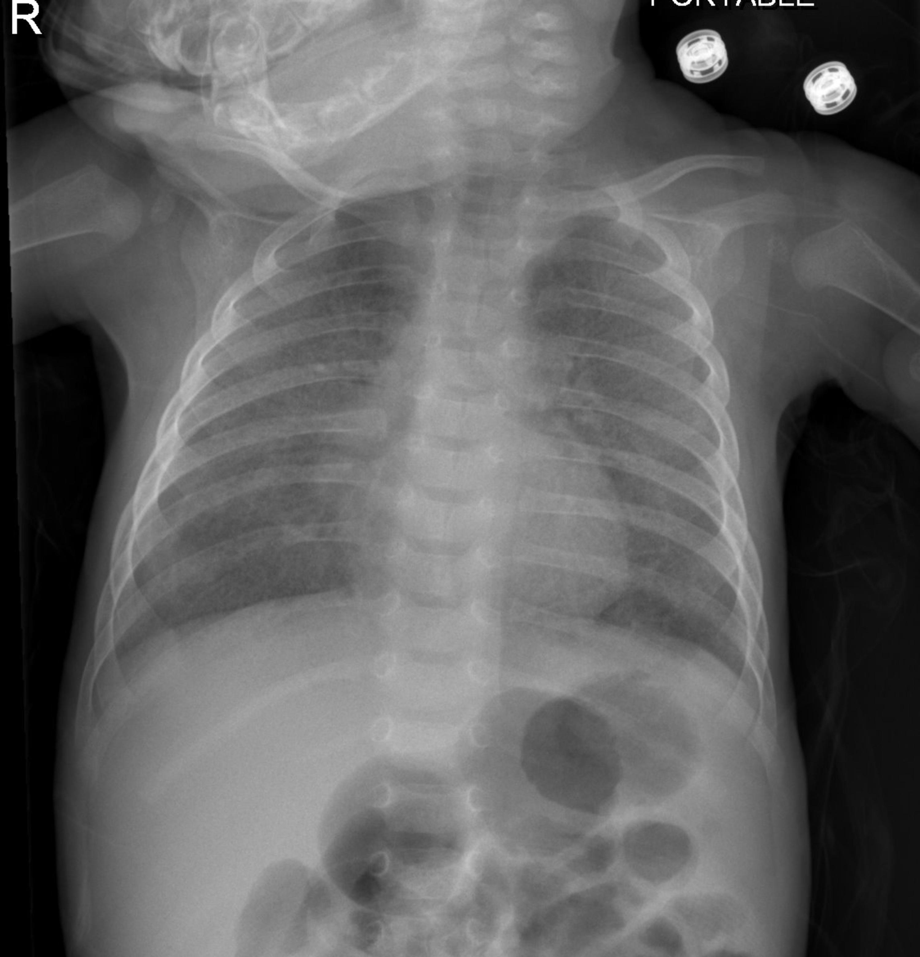 Cureus | Childhood Interstitial Lung Disease Masquerading as Post COVID ...