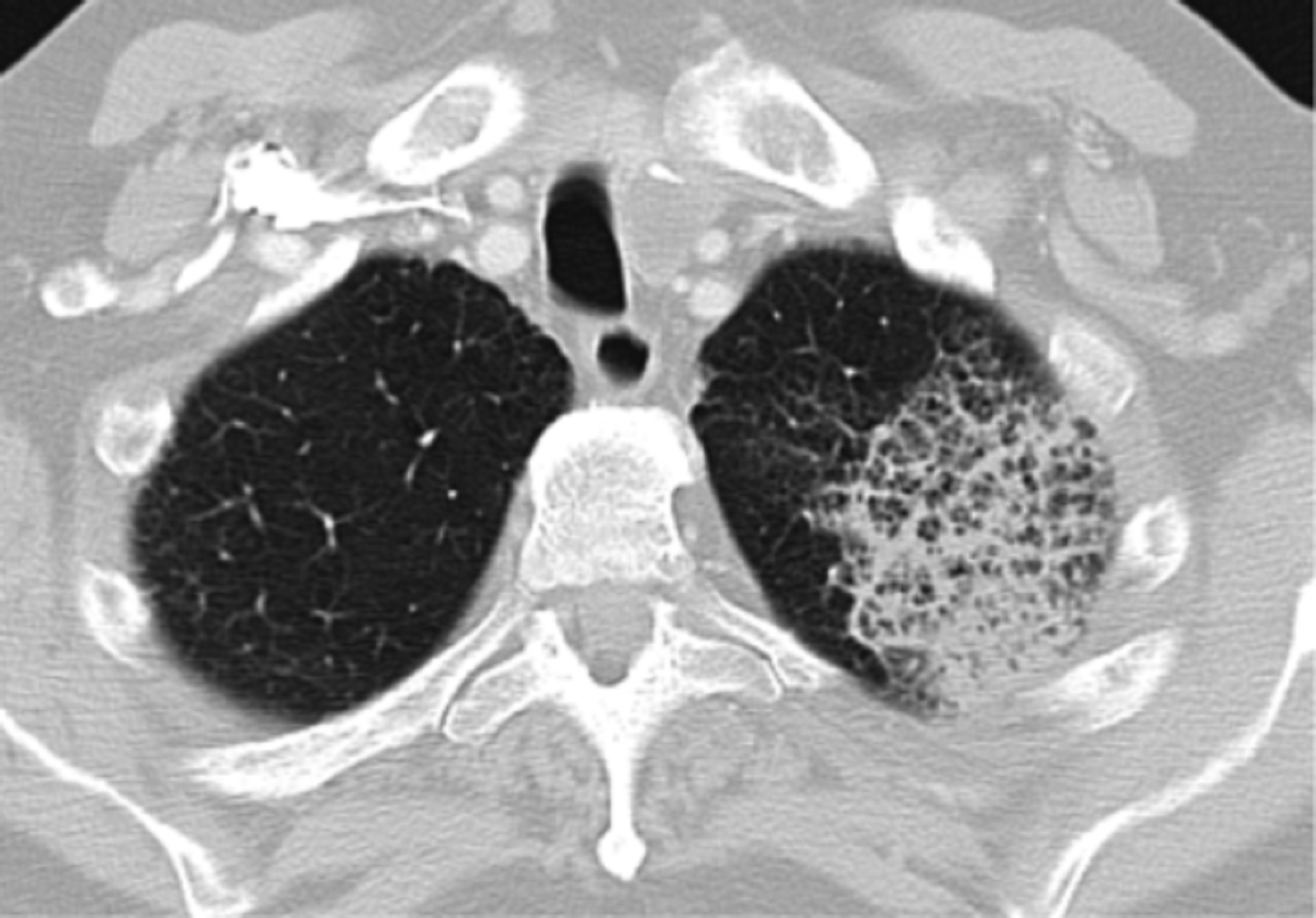 Cureus A Case of junii Cavitary Pneumonia With
