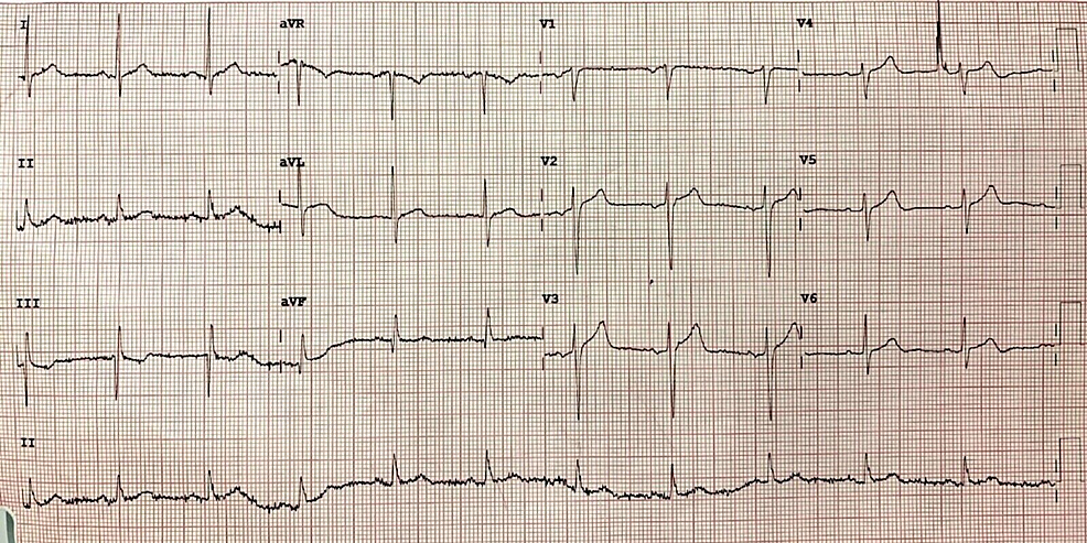 Twelve-lead-electrocardiogram-on-arrival-in-the-emergency-room-shows-normal-sinus-rhythm-with-no-ST/T-changes-suggestive-of-ischemia.