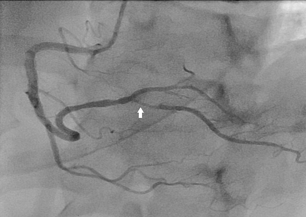 Initial-angiogram-of-RCA-shows-the-patent-stent-in-the-mid-segment-of-RCA-and-severe-disease-in-ostioproximal-segment-of-the-right-posterior-descending-artery-(arrow).