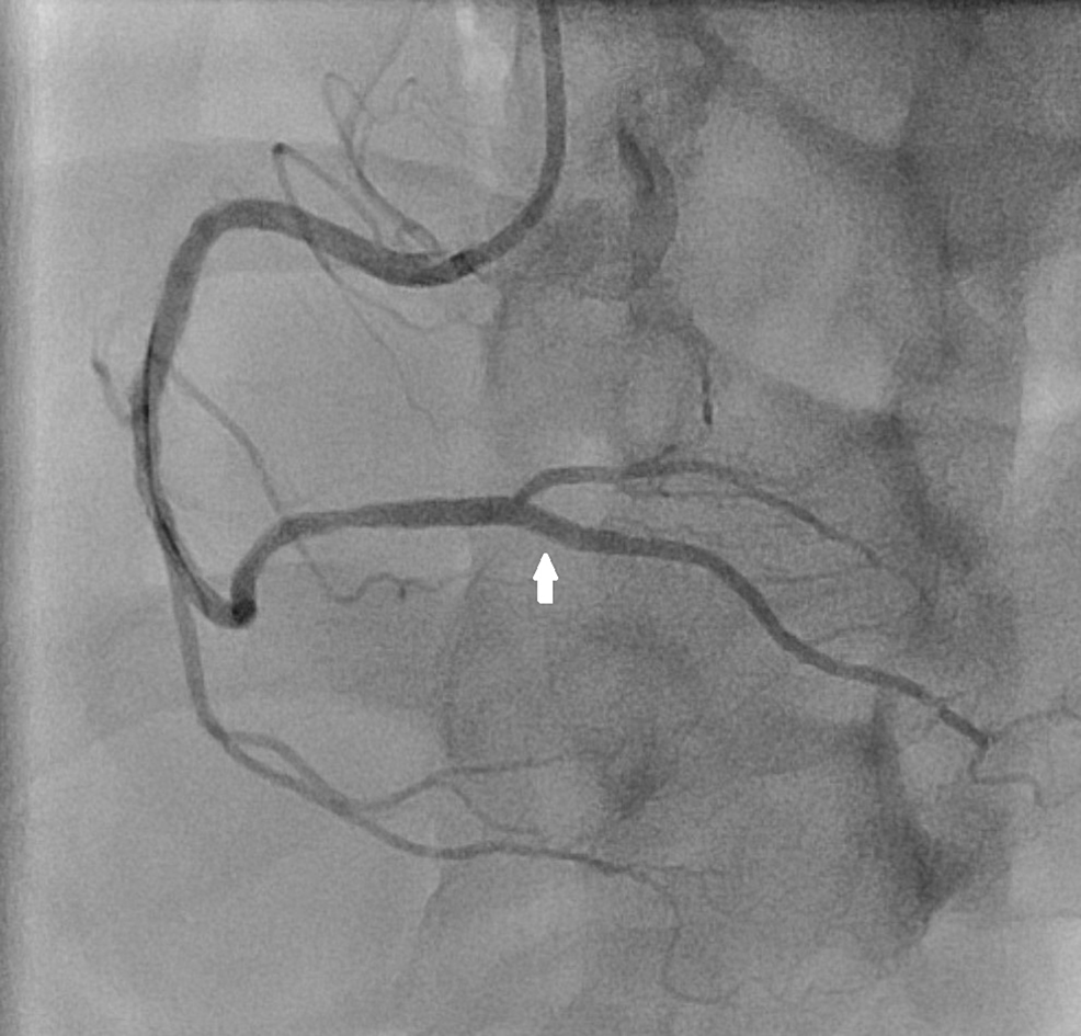 RCA-angiogram-after-percutaneous-coronary-intervention-shows-optimally-expanded-ostioproximal-segment-of-right-posterior-descending-artery-(arrow).