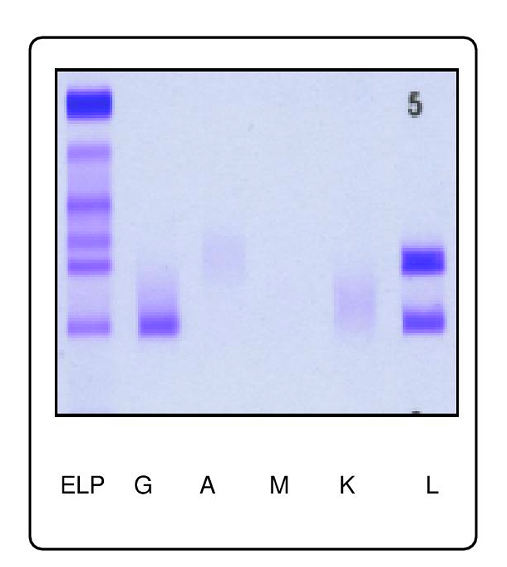 Acid-violet-staining-for-immunofixation-electrophoresis-shows-monoclonal-IgG-lambda-paraproteinaemia