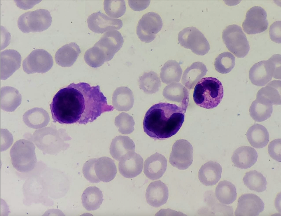 Bone-marrow-aspirate-shows-50%-of-neoplastic-plasma-cells