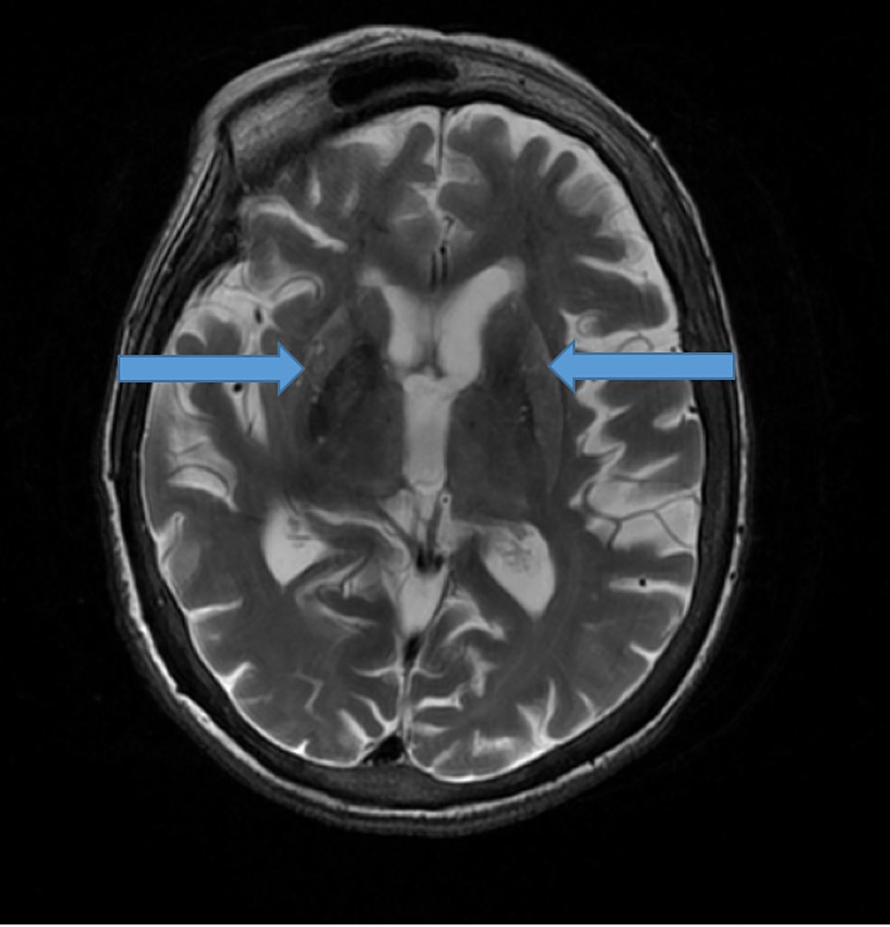 T2-weighted-magnetic-resonance-image-showing-bilateral-symmetric-signal-abnormality-involving-the-caudate-and-putamen-(blue-arrows).
