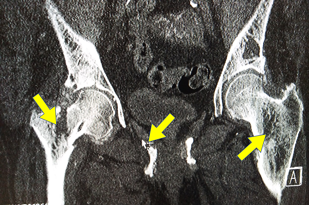 Cureus Hip Fracture in a Patient with Primary Hyperparathyroidism