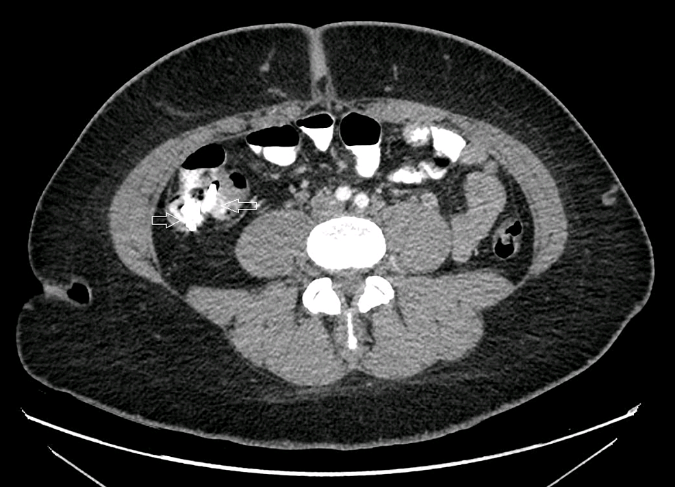 Cureus PeptoBismol Tablets Resembling Foreign Bodies on Abdominal