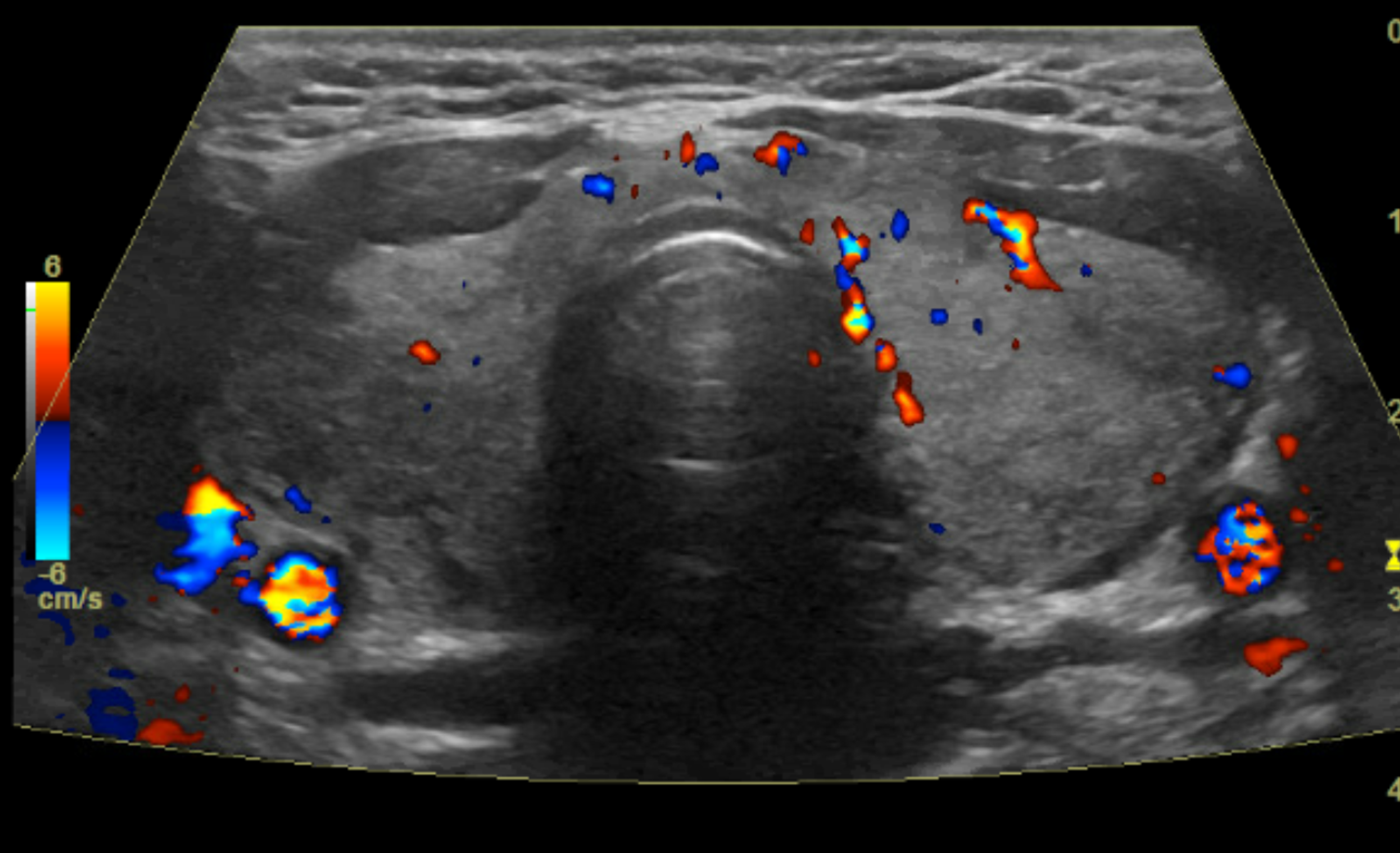 Cureus Elevated Graves’ DiseaseSpecific ThyroidStimulating