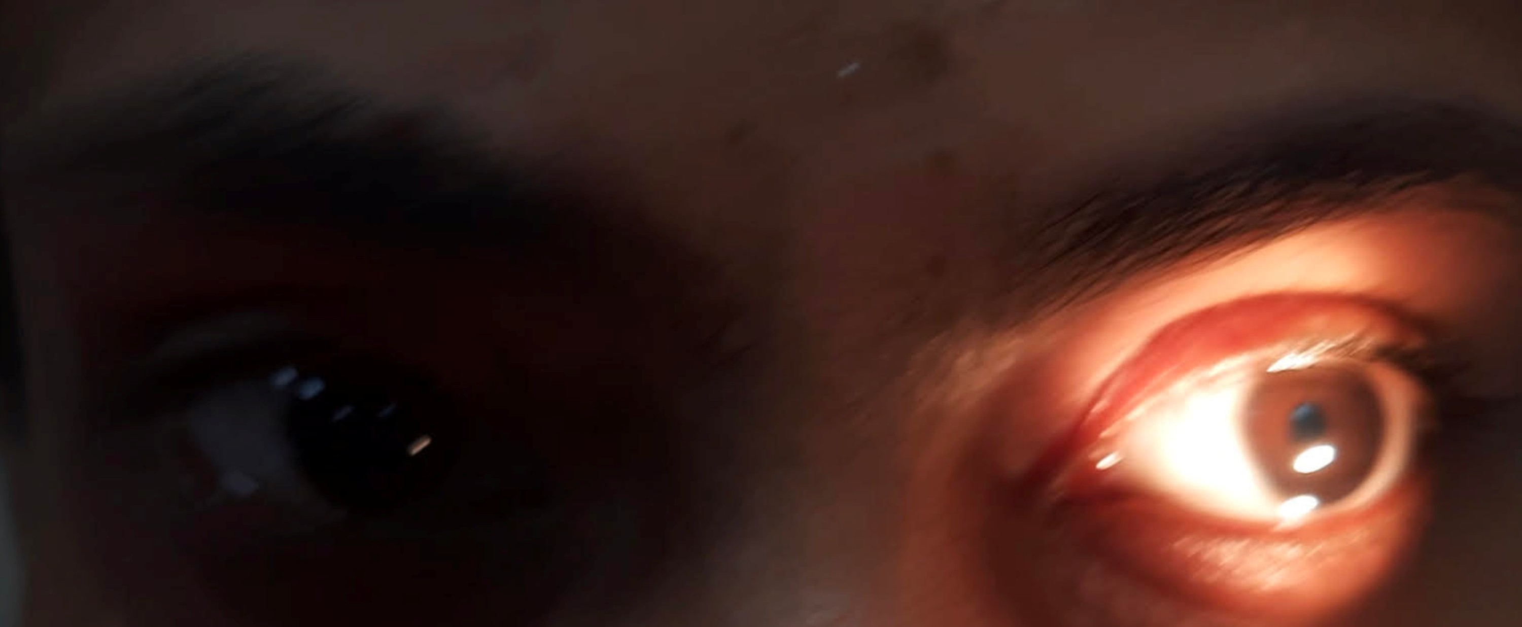 Cureus Two Cases of Tonic Pupil Ross and Ross Syndrome Plus