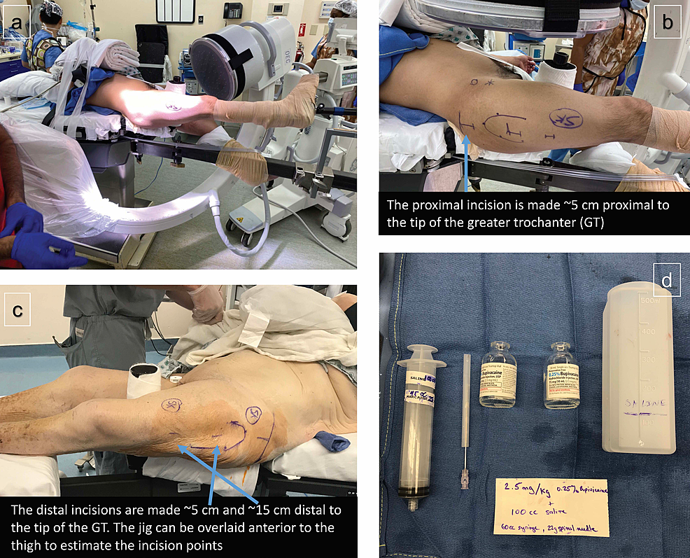 Cureus Monitored Anesthesia Care and SoftTissue Infiltration With