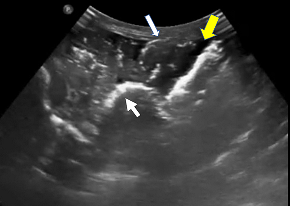 Bedside-ultrasound-image-obtained-from-the-lower-abdomen-(transverse-view)-using-curvilinear-probe,-demonstrating-edematous-bowel-wall-with-intra-mural-air-which-appeared-as-hyper-echoic-lining-along-the-bowel-wall-(white-arrows)-suggestive-of-pneumatosis-intestinalis.-There-was-also-free-fluid-demonstrated-in-the-ultrasound-image-as-shown-by-the-yellow-arrow.