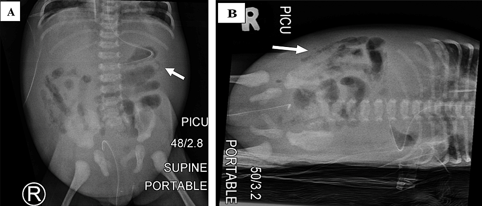 Abdominal-radiographs:-(A)-supine-and-(B)-left-lateral-decubitus-radiographs-showed-radiologic-features-of-pneumatosis-intestinalis-(white-arrow).